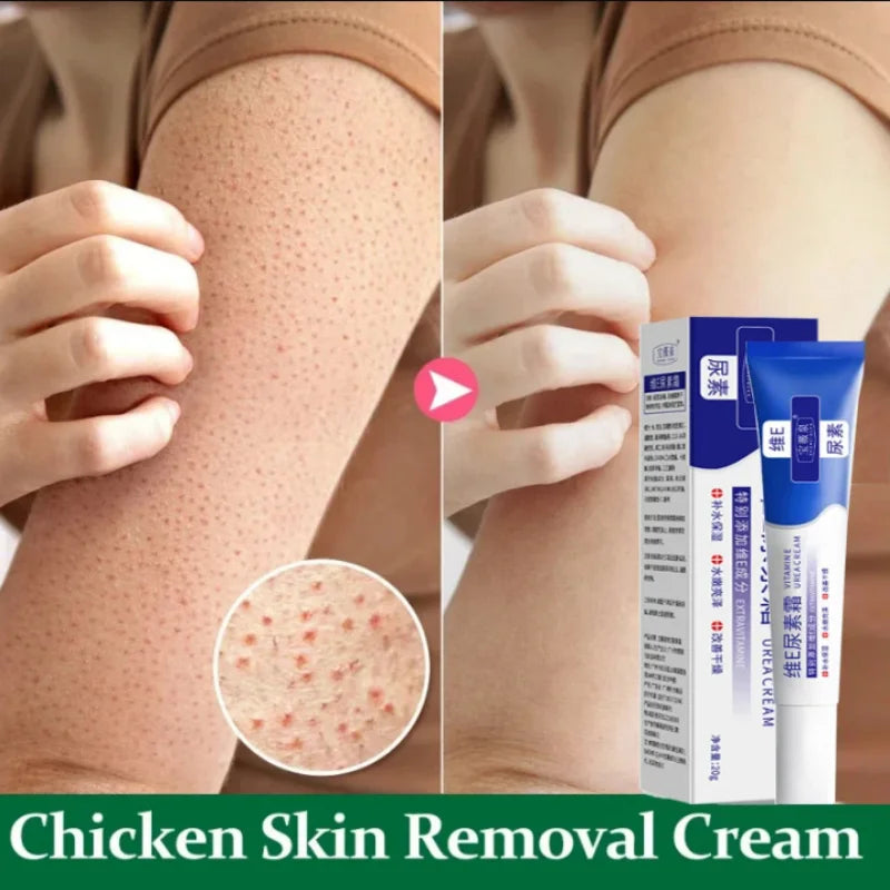 Curing Keratosis Pilaris Chicken Follicle Skin Repair Cream Body Dark Spot Remove Whiten Smooth Moisturize Skincare Body Lotion