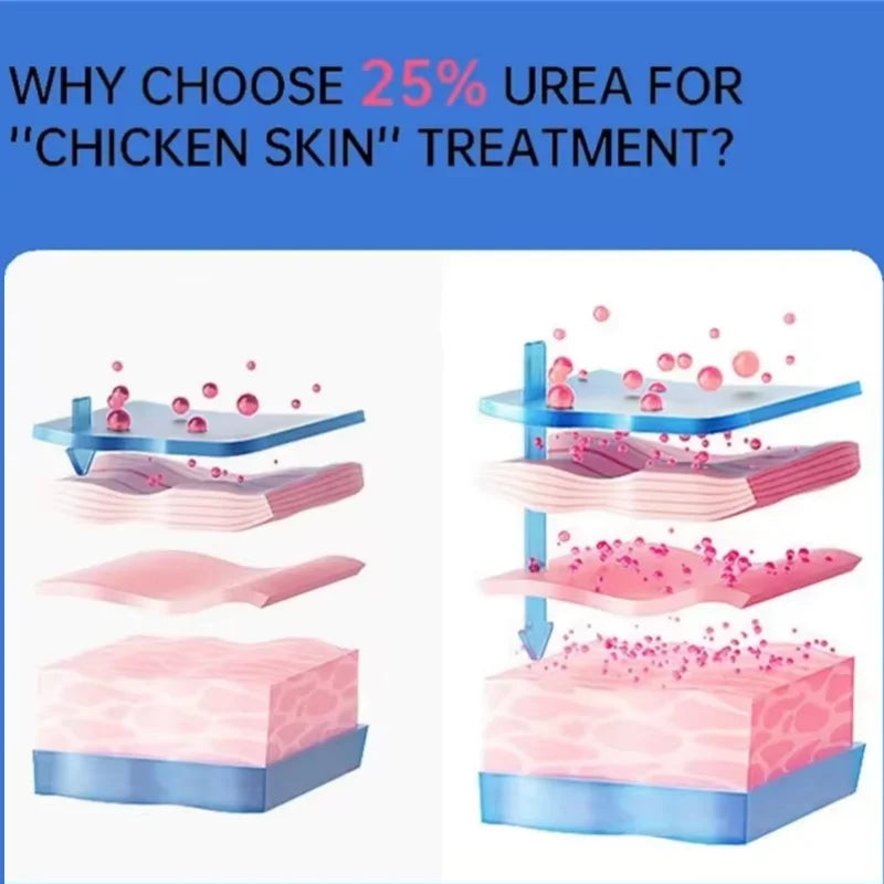 Curing Keratosis Pilaris Chicken Follicle Skin Repair Cream Body Dark Spot Remove Whiten Smooth Moisturize Skincare Body Lotion