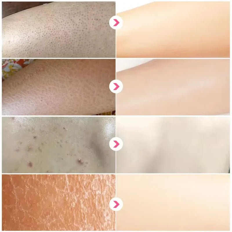 Curing Keratosis Pilaris Chicken Follicle Skin Repair Cream Body Dark Spot Remove Whiten Smooth Moisturize Skincare Body Lotion